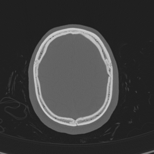 Normal CT skull (Radiopaedia 40798-43459 A 132).png