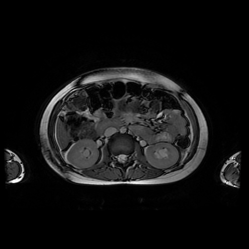 File:Normal MRI abdomen in pregnancy (Radiopaedia 88001-104541 Axial Gradient Echo 22).jpg