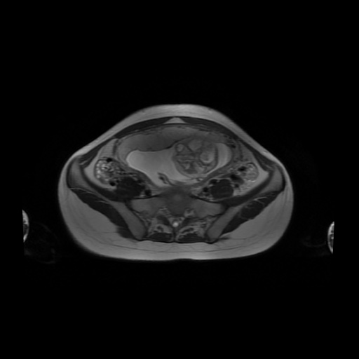 File:Normal MRI abdomen in pregnancy (Radiopaedia 88001-104541 Axial T2 49).jpg