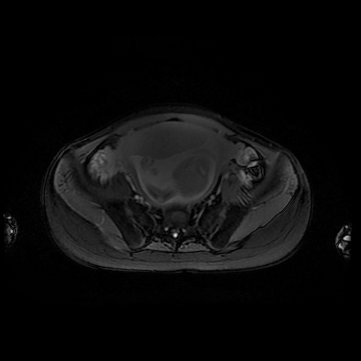 File:Normal MRI abdomen in pregnancy (Radiopaedia 88001-104541 D 42).jpg