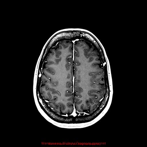 Normal adult brain MRI (non-enhanced and contrast-enhanced) (Radiopaedia 75262-86379 Axial T1 C+ 138).jpg