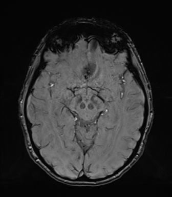 Normal brain MRI (TLE protocol) (Radiopaedia 40748-43405 Axial SWI 38).png