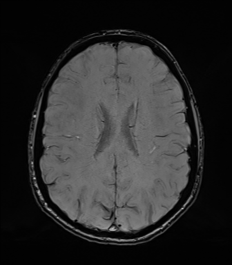 Normal brain MRI (TLE protocol) (Radiopaedia 40748-43405 Axial SWI 55).png