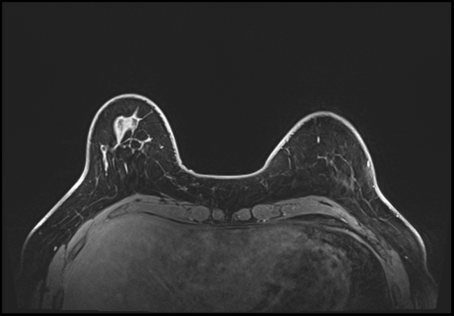 Normal breast MRI - dense breasts (Radiopaedia 80454-93850 C 47).jpg