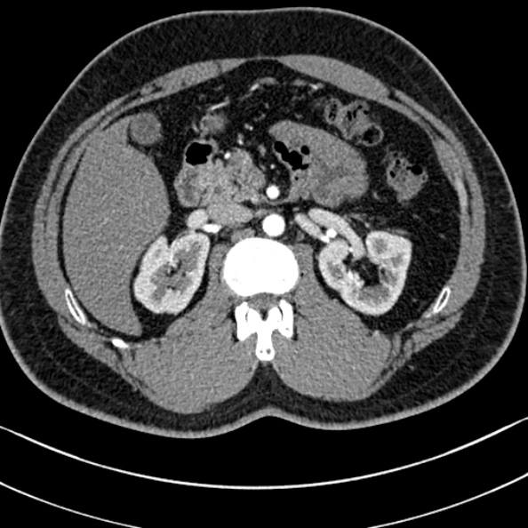 Normal kidneys on 4-phase CT study (Radiopaedia 25889-26038 B 29).jpg