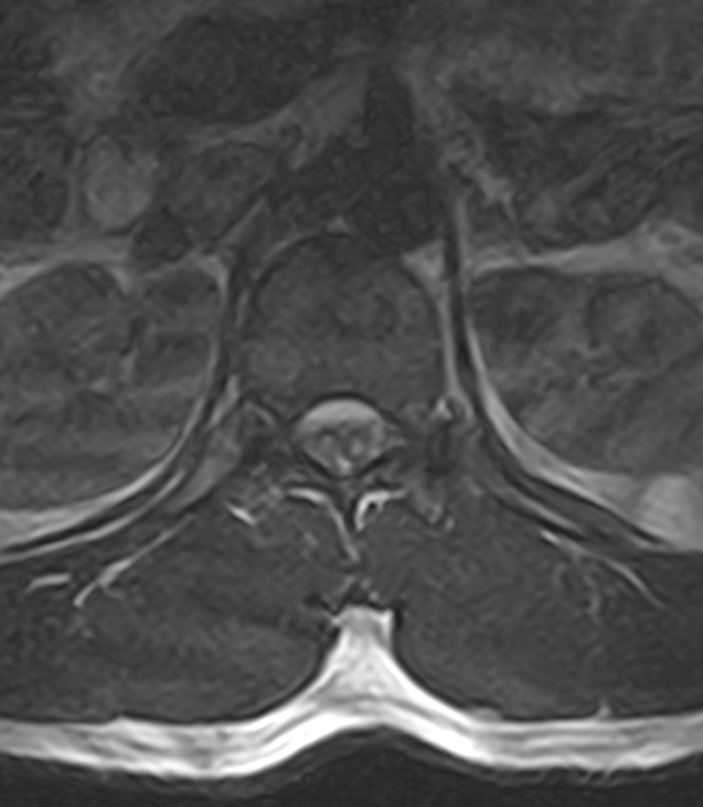 Normal lumbar spine MRI - low-field MRI scanner (Radiopaedia 40976-43699 Axial T2 14).jpg