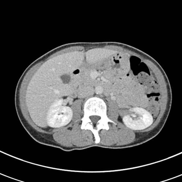 File:Normal multiphase CT liver (Radiopaedia 38026-39996 C 35).jpg