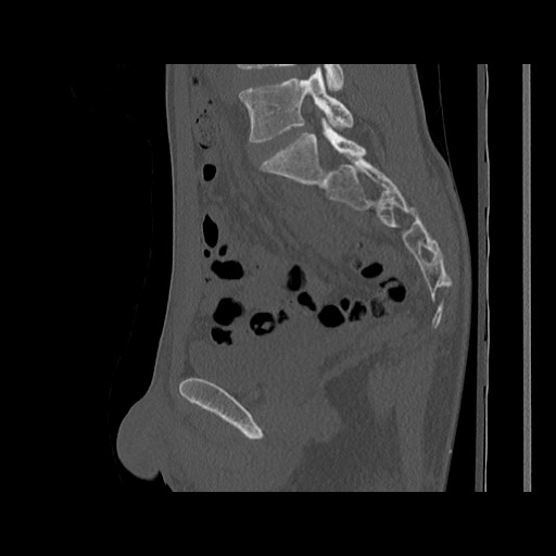 Normal pelvis (Radiopaedia 51473-57238 Sagittal bone window 69).jpg