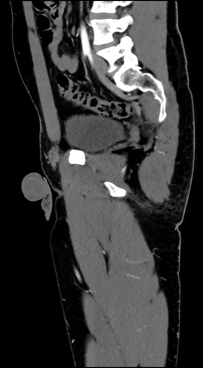 Normal pelvis CT angiogram (Radiopaedia 84966-100481 C 65).jpg