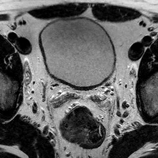 File:Normal prostate (MRI) (Radiopaedia 29986-30535 Axial T2 25).jpg
