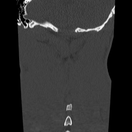 File:Normal trauma cervical spine (Radiopaedia 41017-43760 Coronal bone window 41).png