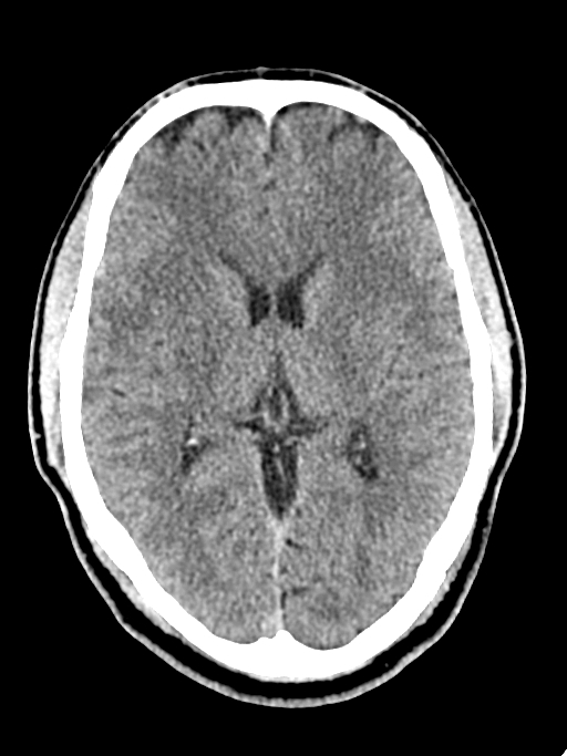 Normal trauma protocol brain and C-spine CT (Radiopaedia 83302-97709 Axial non-contrast 37).jpg