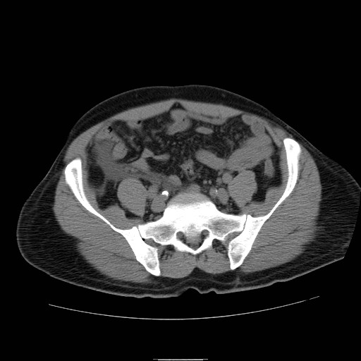 File:Obstructed kidney with perinephric urinoma (Radiopaedia 26889-27066 Axial non-contrast 48).jpg
