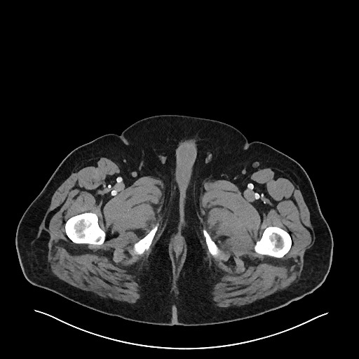 File:Obstructing sigmoid adenocarcinoma (Radiopaedia 58465-65619 A 178).jpg