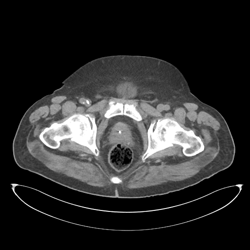 File:Obstructive pyelonephritis (Radiopaedia 46411-50844 Axial non-contrast 77).png