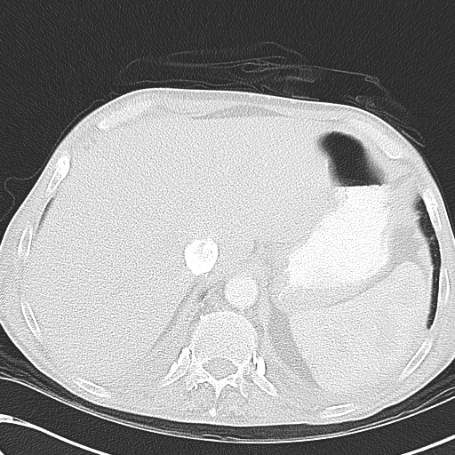 File:Obstructive superior vena cava tumor thrombus (Radiopaedia 28046-28306 Axial lung window 50).jpg