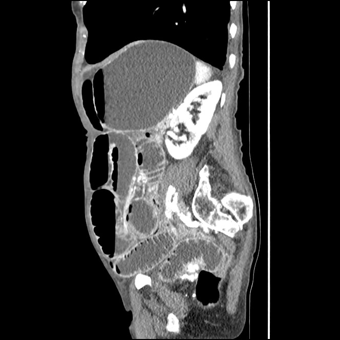 Obturator hernia causing small bowel obstruction (Radiopaedia 65522-74612 C 30).jpg