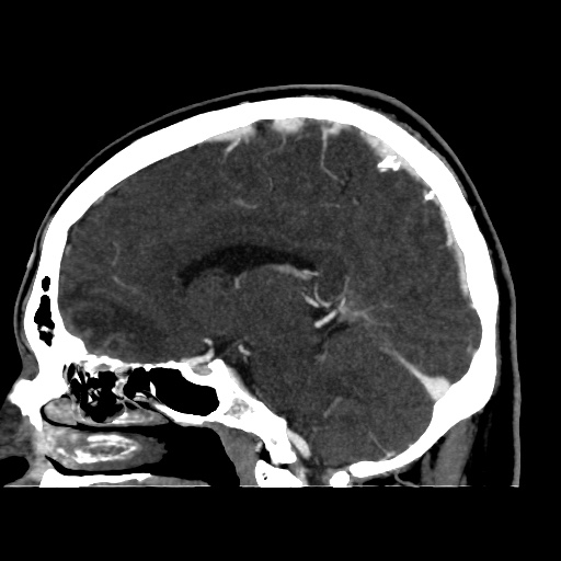 Occipital extradural hematoma simulating venous sinus thrombosis (Radiopaedia 46514-50964 D 43).jpg