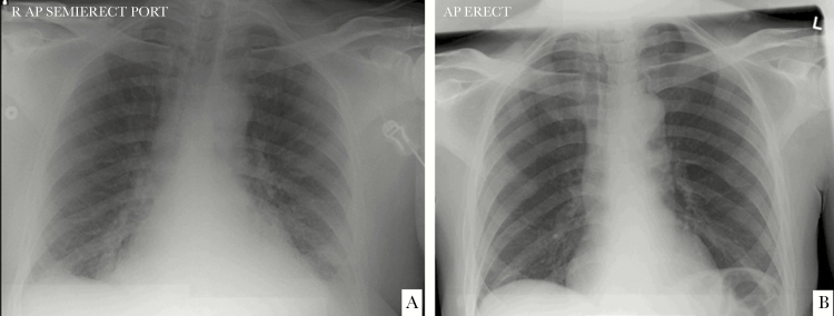 a)Chest x-ray from individual at time of CoV-HKU1 diagnosis b) chest x-ray 1-year before