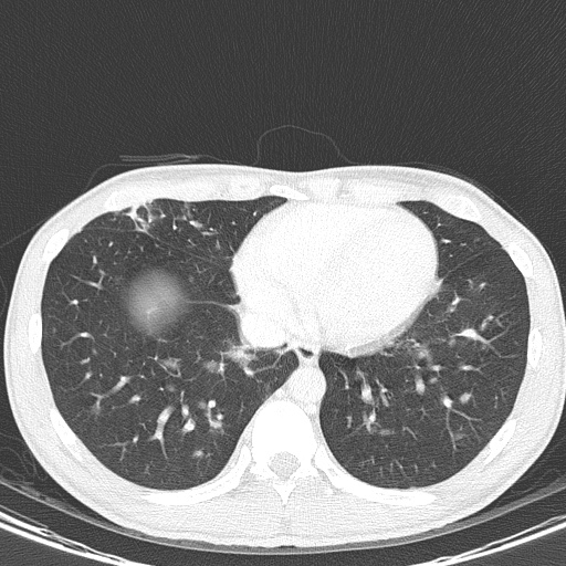 AIDS-related Kaposi sarcoma (Radiopaedia 85247-100811 Axial lung window 128).jpg