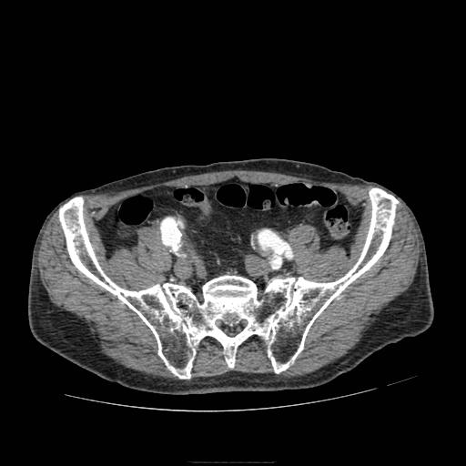 File:Abdominal aortic aneurysm (Radiopaedia 13341-13340 Axial C+ arterial phase 186).jpg