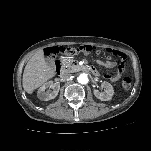 Abdominal aortic aneurysm (Radiopaedia 13341-13340 Axial C+ arterial phase 77).jpg