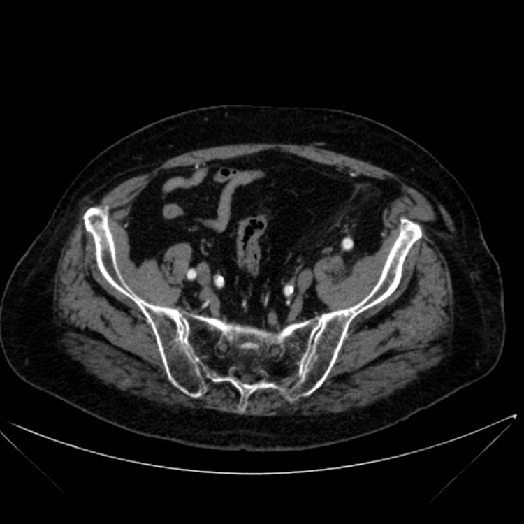 Abdominal aortic aneurysm (Radiopaedia 25855-26001 Axial C+ arterial phase 107).jpg