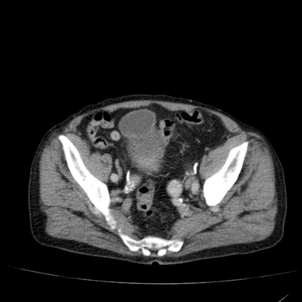 Abdominal aortic aneurysm (Radiopaedia 29248-29660 Axial C+ portal venous phase 51).jpg