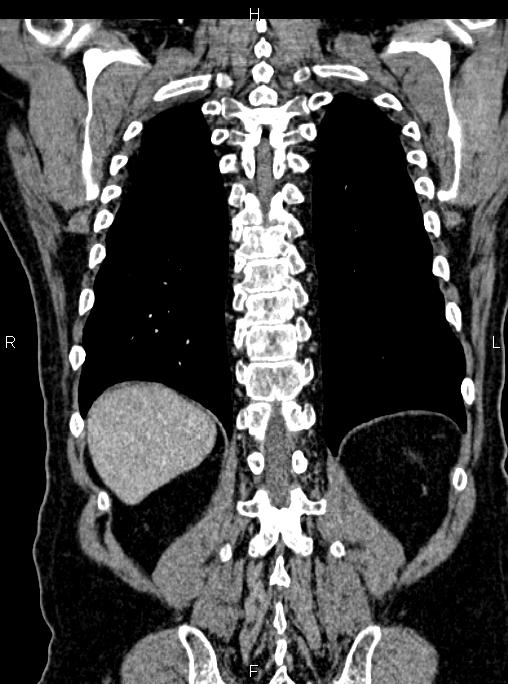 Abdominal aortic aneurysm (Radiopaedia 83094-97462 Coronal renal cortical phase 73).jpg