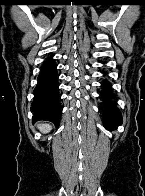 Abdominal aortic aneurysm (Radiopaedia 83094-97462 Coronal renal cortical phase 81).jpg