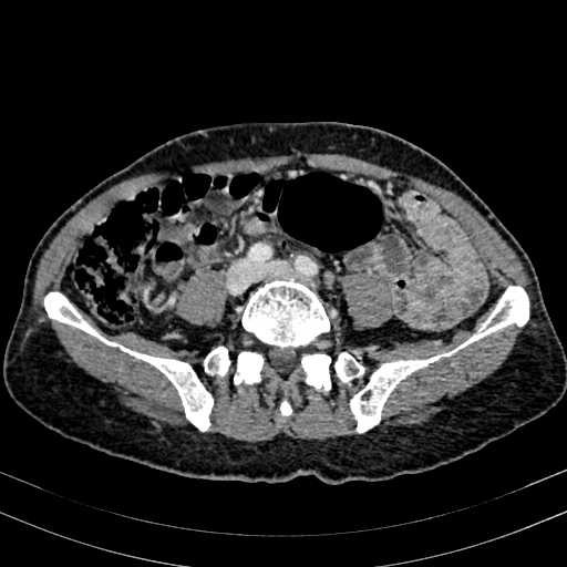 Abdominal aortic aneurysm (Radiopaedia 83581-98689 Axial C+ portal venous phase 74).jpg