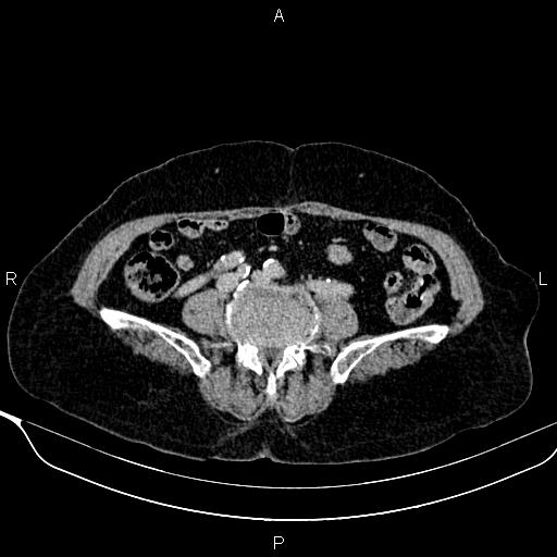 File:Abdominal aortic aneurysm (Radiopaedia 85063-100606 Axial C+ delayed 90).jpg
