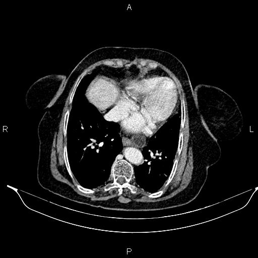 File:Abdominal aortic aneurysm (Radiopaedia 85063-100606 Axial C+ portal venous phase 24).jpg