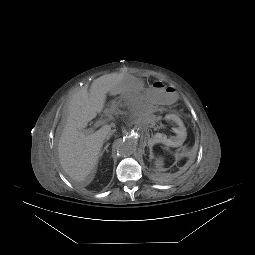 Abdominal aortic aneurysm - impending rupture (Radiopaedia 19233-19247 Axial non-contrast 58).jpg