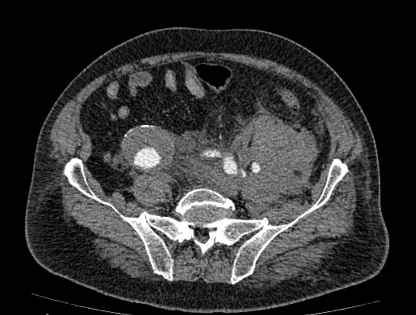 Abdominal aortic aneurysm rupture (Radiopaedia 54179-60362 Axial C+ portal venous phase 10).jpg