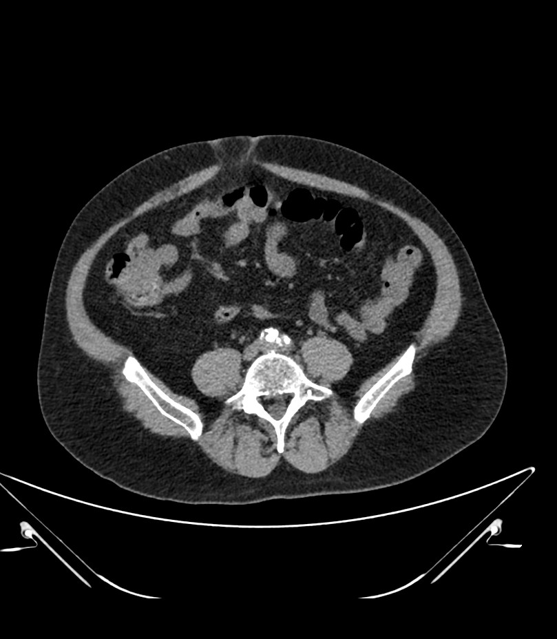 Abdominal aortic aneurysm with thrombus fissuration (Radiopaedia 46218-50618 Axial non-contrast 36).jpg