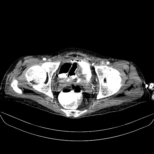 File:Abdominal collection due to previous cecal perforation (Radiopaedia 80831-94320 Axial C+ portal venous phase 192).jpg