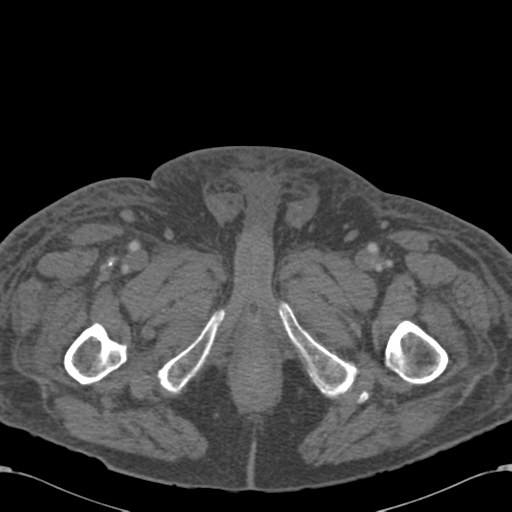 Abdominal hematoma (Radiopaedia 33614-34715 Axial C+ portal venous phase 146).png