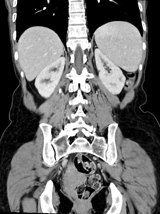 Abdominal wall and retroperitoneal tuberculosis (Radiopaedia 88137-104729 Coronal C+ portal venous phase 74).jpg