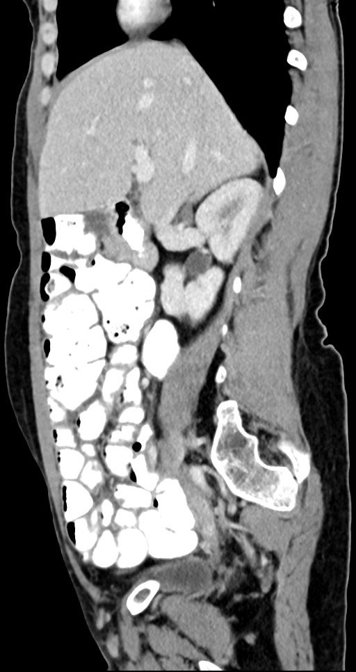 Abdominal wall and retroperitoneal tuberculosis (Radiopaedia 88137-104729 Sagittal C+ portal venous phase 96).jpg