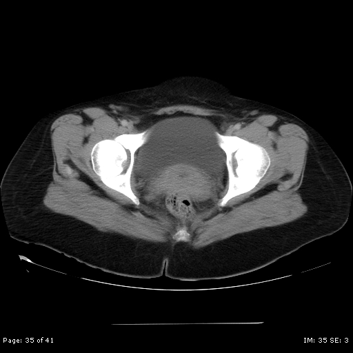 File:Abdominal wall endometriosis (Radiopaedia 25723-25885 Axial C+ portal venous phase 35).jpg