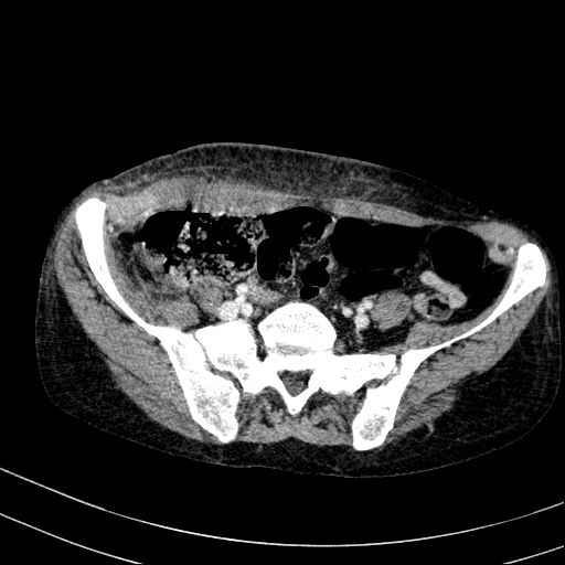 File:Abdominal wall hematoma with active bleeding (Radiopaedia 83915-99117 Axial C+ portal venous phase 95).jpg