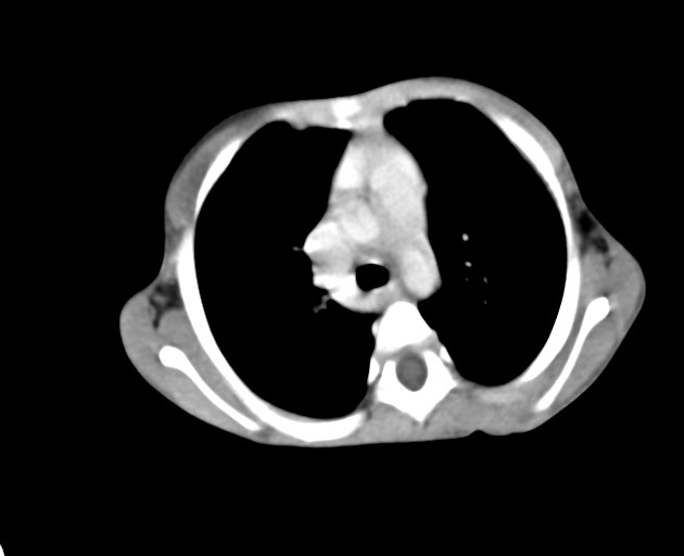File:Abdominopelvic rhabdomyosarcoma (Radiopaedia 78356-90984 Axial C+ portal venous phase 14).jpg