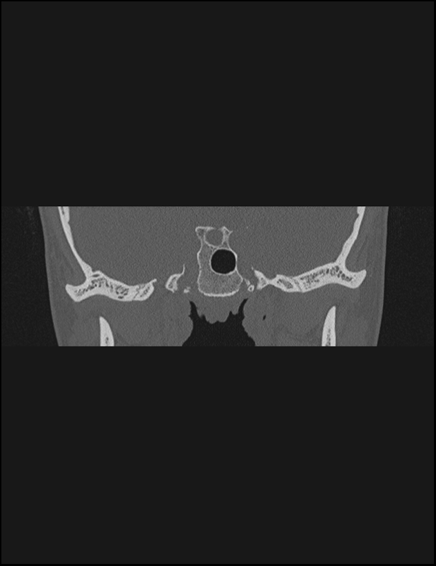 Aberrant right internal carotid artery (Radiopaedia 65191-74198 Coronal non-contrast 14).jpg
