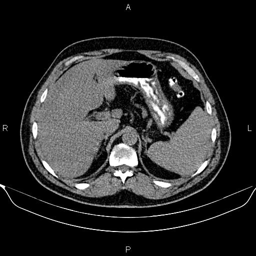 Aberrant right subclavian artery (Radiopaedia 87093-103354 Axial non-contrast 115).jpg