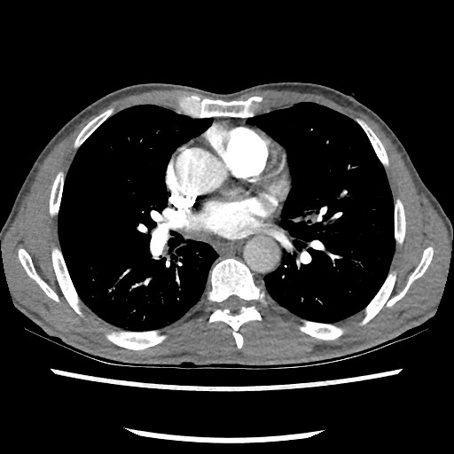 Accessory left horizontal fissure with lingular pneumonia (Radiopaedia 53763-59843 Axial C+ CTPA 51).jpg