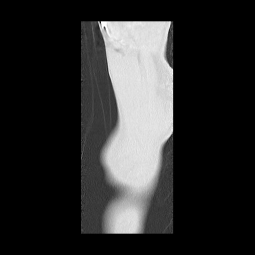 Accessory left horizontal fissure with lingular pneumonia (Radiopaedia 53763-59843 Sagittal lung window 3).jpg