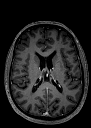 Accessory middle cerebral artery (Radiopaedia 73114-83828 Axial T1 C+ 3).jpg