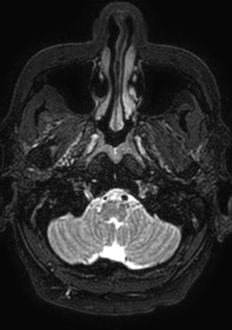 File:Accessory middle cerebral artery (Radiopaedia 73114-83828 Axial T2 207).jpg