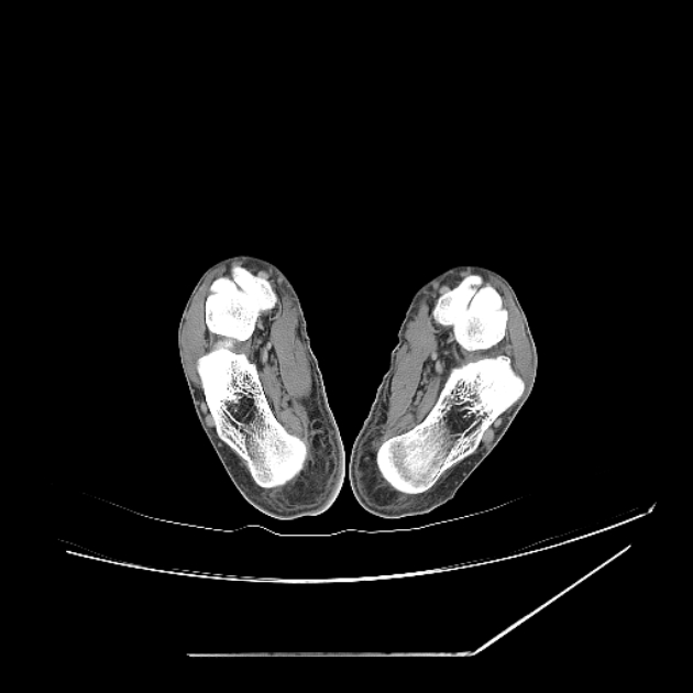 Accessory soleus muscle (Radiopaedia 61069-68943 Axial non-contrast 67).jpg